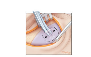 Elevating the fascia off of the underlying temporalis muscle. Getting in the proper plane minimizes bleeding and obtains a cleaner piece of fascia.