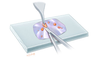 Extra tissue on the fascia can be trimmed on a Teflon block where the fascia is cut to the desired shape.