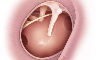 Total tympanic membrane perforation. Total tympanic membrane perforation.