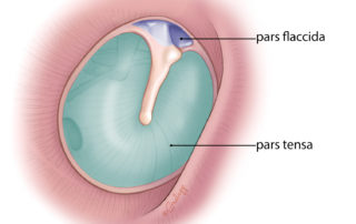 Pars tensa and pars flaccida of the tympanic membrane. The pars tensa has three layers: lateral stratified squamous epithelium, central fibrous layer, and medial low cuboidal mucosal epithelium. The pars flaccida is deficient in its fibrous layer. Pars tensa and pars flaccida of the tympanic membrane. The pars tensa has three layers: lateral stratified squamous epithelium, central fibrous layer, and medial low cuboidal mucosal epithelium. The pars flaccida is deficient in its fibrous layer.