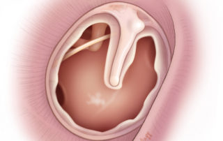 Near-total tympanic membrane perforation with a small remaining rim at the annulus. Near-total tympanic membrane perforation with a small remaining rim at the annulus.