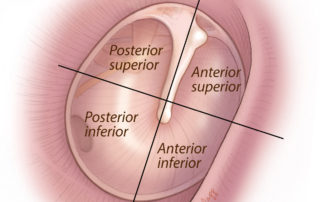 Quadrants of the tympanic membrane. Quadrants of the tympanic membrane.