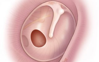 Posterior central tympanic membrane perforation. Perforations such as this one, which lie posterior to the malleus, can be addressed with a transcanal approach to tympanoplasty. Posterior central tympanic membrane perforation. Perforations such as this one, which lie posterior to the malleus, can be addressed with a transcanal approach to tympanoplasty.