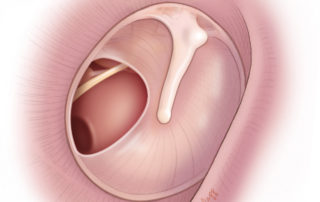 Posterior marginal tympanic membrane perforation. The location over the round window leads to a greater conductive hearing loss due to phase cancellation. Posterior marginal tympanic membrane perforation. The location over the round window leads to a greater conductive hearing loss due to phase cancellation.