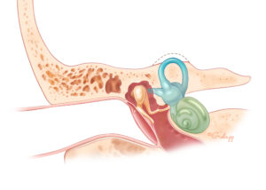 Isolated superior semicircular canal dehiscence.