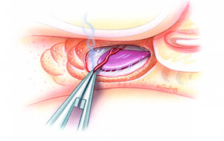 The goal of sac decompression is not merely to identify its edge, but rather to remove bone completely from its lateral surface along with 1 to 2 mm of surrounding dura. Care must be taken to avoid injury to the endolymphatic aqueduct where it penetrates the otic capsule superiorly. While the entire sac is accessible in the great majority of cases, in a few percent it may lie either predominantly or even completely deep to the posterior semicircular canal. A small vessel typically traverses the apex of the sac. It is often injured during bone removal and must be controlled with either bipolar cautery or an absorbable gelatin sponge pledget. The goal of sac decompression is not merely to identify its edge, but rather to remove bone completely from its lateral surface along with 1 to 2 mm of surrounding dura. Care must be taken to avoid injury to the endolymphatic aqueduct where it penetrates the otic capsule superiorly. While the entire sac is accessible in the great majority of cases, in a few percent it may lie either predominantly or even completely deep to the posterior semicircular canal. A small vessel typically traverses the apex of the sac. It is often injured during bone removal and must be controlled with either bipolar cautery or an absorbable gelatin sponge pledget.