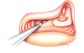 A patch of posterior fossa dura is bared beneath the inferior margin of the posterior semicircular canal. It is usually not necessary to skeletonize this canal in order to gain adequate exposure. When an extensive retrofacial cell tract exists, the pneumatized cells can be safely and rapidly removed en route to the sac. The lower margin of the otic capsule can usually be appreciated by its denser nature, its more yellow color, and its fine pattern of superficial blood vessels. A patch of posterior fossa dura is bared beneath the inferior margin of the posterior semicircular canal. It is usually not necessary to skeletonize this canal in order to gain adequate exposure. When an extensive retrofacial cell tract exists, the pneumatized cells can be safely and rapidly removed en route to the sac. The lower margin of the otic capsule can usually be appreciated by its denser nature, its more yellow color, and its fine pattern of superficial blood vessels.
