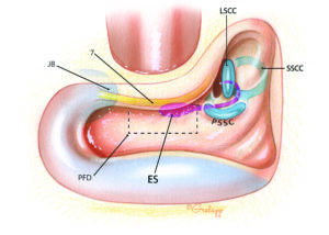 In preparation for exposure of the endolymphatic sac, an intact canal wall mastoidectomy is performed. In contrast to many drawings which appear in otologic texts, the sac does not reside on the posterior fossa dura superficially in the mastoid. Instead it is positioned rather medially and sits inferior to the labyrinth. Surgical exposure of the sac is carried out through a roughly rectangular window (dashed line) which, when pneumatized, is known as the retrofacial air cell tract. This is bounded anteriorly by the mastoid segment of the facial nerve, posteriorly by the posterior fossa dura, superiorly by the posterior semicircular canal, and inferiorly by the jugular bulb. ES, endolymphatic sac; JB, jugular bulb; PFD, posterior fossa dura; 7, facial nerve; PSCC, posterior semicircular canal; LSCC, lateral semicircular canal; SSCC, superior semicircular canal.