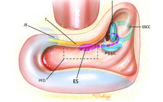 In preparation for exposure of the endolymphatic sac, an intact canal wall mastoidectomy is performed. In contrast to many drawings which appear in otologic texts, the sac does not reside on the posterior fossa dura superficially in the mastoid. Instead it is positioned rather medially and sits inferior to the labyrinth. Surgical exposure of the sac is carried out through a roughly rectangular window (dashed line) which, when pneumatized, is known as the retrofacial air cell tract. This is bounded anteriorly by the mastoid segment of the facial nerve, posteriorly by the posterior fossa dura, superiorly by the posterior semicircular canal, and inferiorly by the jugular bulb. ES, endolymphatic sac; JB, jugular bulb; PFD, posterior fossa dura; 7, facial nerve; PSCC, posterior semicircular canal; LSCC, lateral semicircular canal; SSCC, superior semicircular canal. In preparation for exposure of the endolymphatic sac, an intact canal wall mastoidectomy is performed. In contrast to many drawings which appear in otologic texts, the sac does not reside on the posterior fossa dura superficially in the mastoid. Instead it is positioned rather medially and sits inferior to the labyrinth. Surgical exposure of the sac is carried out through a roughly rectangular window (dashed line) which, when pneumatized, is known as the retrofacial air cell tract. This is bounded anteriorly by the mastoid segment of the facial nerve, posteriorly by the posterior fossa dura, superiorly by the posterior semicircular canal, and inferiorly by the jugular bulb. ES, endolymphatic sac; JB, jugular bulb; PFD, posterior fossa dura; 7, facial nerve; PSCC, posterior semicircular canal; LSCC, lateral semicircular canal; SSCC, superior semicircular canal.
