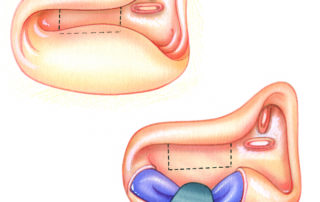 When the sigmoid sinus is anteriorly placed, it can obstruct visualization of the retrofacial cell tract (dashed lines). In extreme cases, the sinus may even contact the posterior aspect of the ear canal. To accommodate for the anatomical variation of an anteriorly placed sigmoid sinus, bone is removed from the vessel’s surface with a diamond burr and it is gently retracted. This maneuver provides ample access to the region of the endolymphatic sac. When the sigmoid sinus is anteriorly placed, it can obstruct visualization of the retrofacial cell tract (dashed lines). In extreme cases, the sinus may even contact the posterior aspect of the ear canal. To accommodate for the anatomical variation of an anteriorly placed sigmoid sinus, bone is removed from the vessel’s surface with a diamond burr and it is gently retracted. This maneuver provides ample access to the region of the endolymphatic sac.