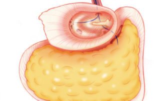 Management of CSF otorhinorrhea illustrated by leakage occurring after a translabyrinthine approach to acoustic neuroma. In this case, CSF traverses the fat graft in the petrous defect to pass through the aditus to the middle ear and then via the Eustachian tube to the nasopharynx (arrow). Management of CSF otorhinorrhea illustrated by leakage occurring after a translabyrinthine approach to acoustic neuroma. In this case, CSF traverses the fat graft in the petrous defect to pass through the aditus to the middle ear and then via the Eustachian tube to the nasopharynx (arrow).