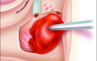 In a nonhearing ear, the labyrinth can be resected to enable a combination of fascia and muscle to directly seal the dural opening. In a nonhearing ear, the labyrinth can be resected to enable a combination of fascia and muscle to directly seal the dural opening.