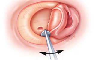 Dissection of the tympanic annulus from its sulcus. Dissection of the tympanic annulus from its sulcus.