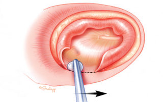 The first stage in obliteration of the middle ear and closure of the Eustachian tube begins with removal of the skin of the external auditory canal. This is important to perform thoroughly to avoid creation of an iatrogenic cholesteatoma. The first stage in obliteration of the middle ear and closure of the Eustachian tube begins with removal of the skin of the external auditory canal. This is important to perform thoroughly to avoid creation of an iatrogenic cholesteatoma.