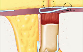 Schematic showing use of hydroxyapatite to obliterate the middle ear and osseous ear canal. Schematic showing use of hydroxyapatite to obliterate the middle ear and osseous ear canal.