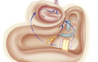 Following a retrosigmoid approach to acoustic neuroma, air cell tracts around the internal auditory canal have been opened. CSF may reach the Eustachian tube via the aditus (common route) or via a direct infralabyrinthine–infracochlear route to the hypotympanum. Following a retrosigmoid approach to acoustic neuroma, air cell tracts around the internal auditory canal have been opened. CSF may reach the Eustachian tube via the aditus (common route) or via a direct infralabyrinthine–infracochlear route to the hypotympanum.