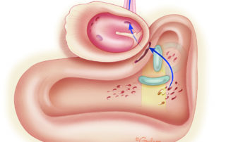 Multiple pathways exist for CSF leakage through the ear. Most common are traumatic and spontaneous leaks that occur via the middle fossa floor (tegmen tympani and mastoideum). Following skull base tumor surgery, the leakage from the posterior fossa flows via perilabyrinthine tracts as shown in the illustration above. Finally, leak may flow though the inner ear, especially when congenitally malformed, or following cochlear implant surgery. (see 11.3 Cochlear Implant Surgical Variations) Multiple pathways exist for CSF leakage through the ear. Most common are traumatic and spontaneous leaks that occur via the middle fossa floor (tegmen tympani and mastoideum). Following skull base tumor surgery, the leakage from the posterior fossa flows via perilabyrinthine tracts as shown in the illustration above. Finally, leak may flow though the inner ear, especially when congenitally malformed, or following cochlear implant surgery. (see 11.3 Cochlear Implant Surgical Variations)