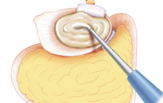 Hydroxyapatite is an alternative means of filling the middle ear and bony ear canal. Hydroxyapatite is an alternative means of filling the middle ear and bony ear canal.