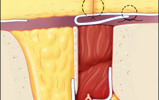 Completed temporal bone obliteration for CSF leak. The technique for ear canal closure to withstand CSF pressure is illustrated in the next section. Completed temporal bone obliteration for CSF leak. The technique for ear canal closure to withstand CSF pressure is illustrated in the next section.