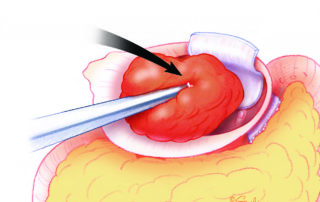 A free graft of temporalis muscle is mortised into the medial ear canal to obliterate the middle ear cavity and hold the fascia in place over the Eustachian tube orifice. A free graft of temporalis muscle is mortised into the medial ear canal to obliterate the middle ear cavity and hold the fascia in place over the Eustachian tube orifice.