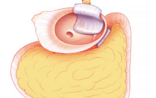 After scraping excess wax from the Eustachian tube orifice, temporalis fascia is placed over the orifice and over the aditus. After scraping excess wax from the Eustachian tube orifice, temporalis fascia is placed over the orifice and over the aditus.