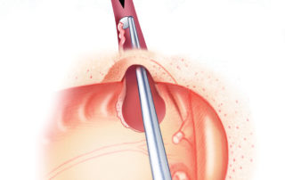 Mucosa is scraped from the Eustachian tube. As the party wall with the carotid artery can be dehiscent, this should be done without excessive vigor. Mucosa is scraped from the Eustachian tube. As the party wall with the carotid artery can be dehiscent, this should be done without excessive vigor.