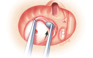 To reduce the likelihood of mucocele formation, mucosa from the middle ear is removed. To reduce the likelihood of mucocele formation, mucosa from the middle ear is removed.