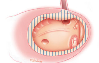 To ensure removal of all squamous remnants, the annular sulcus is drilled away. Note that the bone overlying the Eustachian tube infundibulum must be widely excavated. To ensure removal of all squamous remnants, the annular sulcus is drilled away. Note that the bone overlying the Eustachian tube infundibulum must be widely excavated.