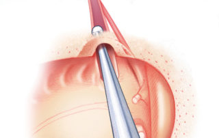 Using a diamond burr, the middle ear orifice of the Eustachian tube is funneled. Using a diamond burr, the middle ear orifice of the Eustachian tube is funneled.