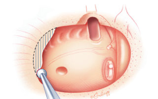 The orifice of the Eustachian tube has been exposed. The orifice of the Eustachian tube has been exposed.
