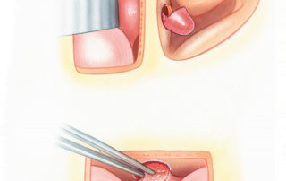 When the brain hernia is necrotic or cannot be reduced, it should be amputated at the level of the cranial base.