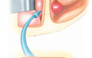 Extradural retraction of the temporal lobe brings into view the base of the hernia.