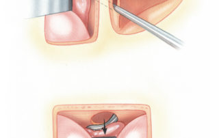 When the brain is not necrotic, an attempt should be made to reduce the hernia back into the temporal fossa.