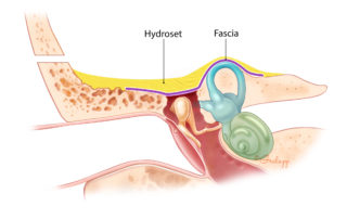 Overview of a repaired temporal floor defect which is best accomplished with a multilayer closure including fascia, bone (either split calvarial or artificial hydroxyapatite as shown here), and sometimes muscle. Fascia is placed both over the bony defect with a second layer placed over the dural defect.