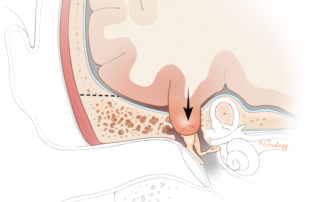 Encephaloceles of the temporal bone with a small brain hernia impinging upon the ossicular chain resulting in conductive hearing loss. This may occur with either intact dura or a dural defect in which case brain may be visible behind the tympanic membrane. Dashed lines show bone cuts for middle fossa extradural repair of the dehiscent tegmen.