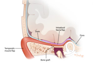 The temporal craniotomy flap has been split with a reciprocating saw to provide a bone graft to cover the widely diastatic gap over the middle ear. A temporalis muscle rotation flap has been used to reinforce the closure. Dural repair may be intradural, as shown here, or extradural.