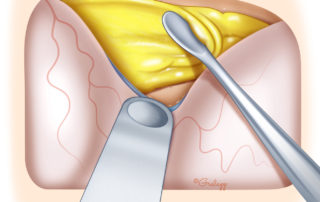 The author’s preferred method is to use fascia followed by hydroxyapatite cement smoothed to cover the cranial base defect as well to reinforce the entire temporal floor to deter recurrence.