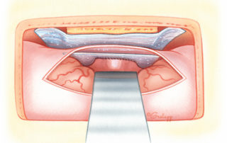 When the dural defect is large, placing a supplemental fascia graft intradurally is desirable. The advantage of an intradural graft is that the weight of the brain helps to coapt the graft with the surrounding dura.