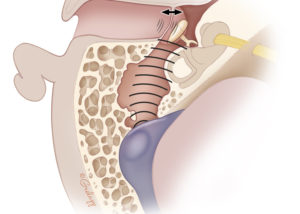 Flow in the venous sinuses is rapid and under high pressure. When the bony covering of the sigmoid sinus is dehiscent, sound generated may pass via the mastoid air cells to the tympanum with it and can vibrate the tympano-ossicular chain resulting in pulsatile tinnitus. This is the most common cause of troubling pulsatile tinnitus.