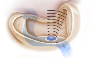 Mastoidectomy exposing the dehiscent segment of the sigmoid sinus. Care is taken not to disturb the intact sigmoid bone covering and to avoid enlarging the dehiscence.