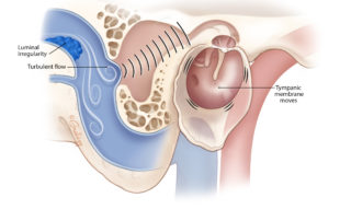 Smooth flow within the sinus generates little noise. Turbulent flow augments the audibility of venous sounds. In many cases, prominent arachnoid granulations impinge upon the lumen in proximity to the transverse–sigmoid sinus junction.