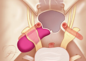 Petrous apex cholesterol granuloma, axial view. This lesion, which extends medial to the carotid artery, has a favorable anatomy for drainage into the sphenoid sinus. V, trigeminal nerve; SS, sphenoid sinus with the intersinus septum removed.