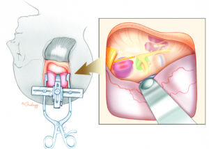 The middle fossa approach may be used for exposure of apical petrous lesions. Examples include tumors such as chondrosarcoma and for the resection of cystic lesions. Cholesterol granuloma of the petrous apex may require resection when they are recurrent or when no lateral (subcochlear or infralabyrinthine) or medial (transsphenoidal) drainage route exists.