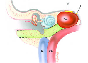 The petrous apex is the medial portion of the petrous bone that lies between the inner ear and the clivus. Petrous “apicectomy” is the term commonly applied to a procedure which reaches the apical portion of the petrous bone by skirting around the inner ear. It is inherently a drainage procedure which creates only a relatively small entry into the apical region. Thus, the commonly used term petrous “apicectomy” is a misnomer when used in this context. Petrous apicotomy would actually be a more accurate description for the procedure. Petrous apicotomy is primarily indicated for drainage of cholesterol granuloma and purulent infections. Fundamentally, there are two routes used to reach the petrous apex: those which pass near the labyrinth and those which skirt the cochlea. In recent years, the hypotympanic–subcochlear route depicted here has become the most popular. The bone removed during this procedure is depicted in this schematic coronal illustration as the color green. Note the relationship of the apical cholesterol granuloma to the fifth and sixth nerves. This explains the frequent occurrence of deep ear and retro-orbital pain as well as diplopia in these lesions. JV, jugular vein; CA, carotid artery; CG, cholesterol granuloma; 5, trigeminal nerve; 6, abducens nerve.