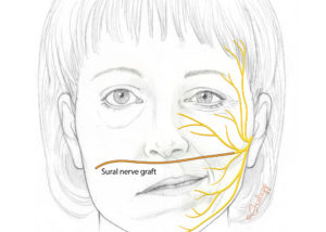 For some cases of chronic facial paralysis, a long nerve graft may be harvested from the leg (not shown) and connected to a donor nerve branch on the nonparalyzed side of the face. The graft is then tunneled underneath the skin to the contralateral side. At a second surgery, this nerve graft may be connected to the gracilis muscle transplanted from the inner thigh region in order to reestablish movement of the corner of the mouth.