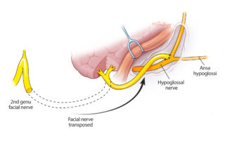 The descending portion of the facial nerve from the mastoid is swung down for an end-to-side anastomosis with the hypoglossal nerve.