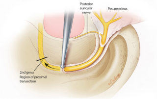 Skeletonization of the facial nerve in the mastoid up to the level of the second genu.