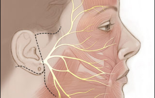 The anatomy of the facial nerve is shown as it travels toward target muscles in the face. Also shown are typical facial incisions for combined hypoglossal-to-facial nerve and masseteric-to-facial nerve transfer procedures for facial reanimation in cases of chronic facial paralysis.