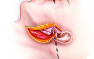 In the initial stages of hypoglossal facial anastomosis procedure, the facial nerve is dissected from its exit from the stylomastoid foramen to the pes anserinus. Note that an extensive cheek flap, as utilized in parotidectomy, is unnecessary.