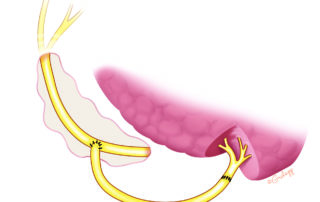 An alternative technique is a jump graft connecting the hypoglossal and facial nerve.